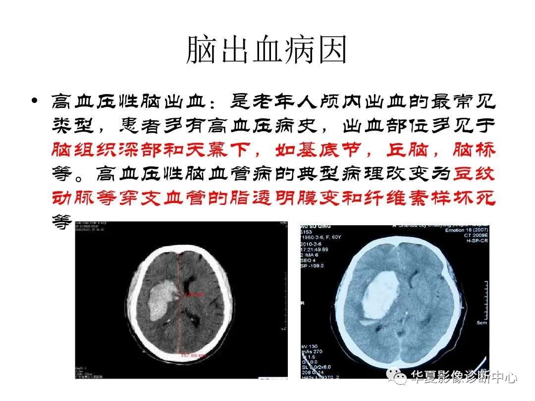 ct如何区分脑淀粉样变脑出血与高血压性脑出血