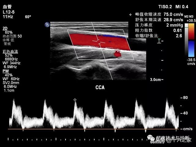 血管超声 | 超声如何辨别颈内动脉与颈外动脉