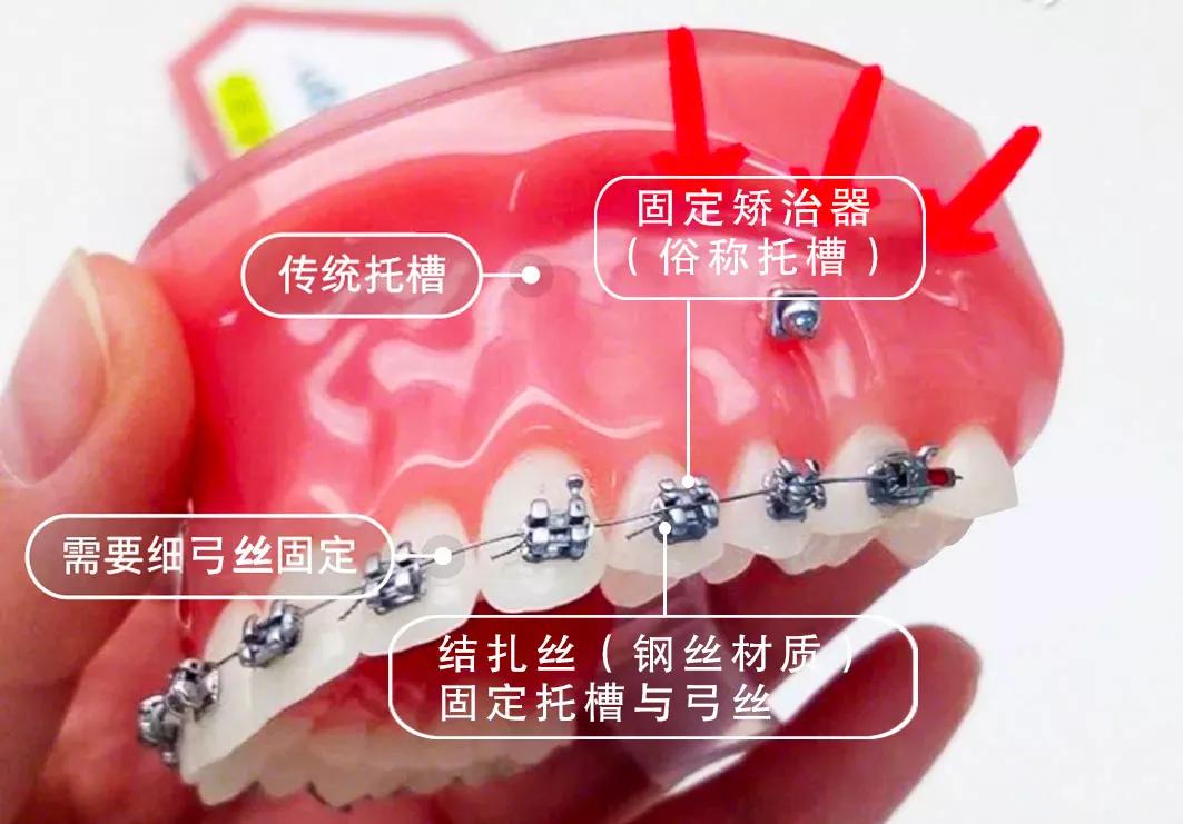 关于牙套二三事!金属陶瓷自锁托槽隐形牙套