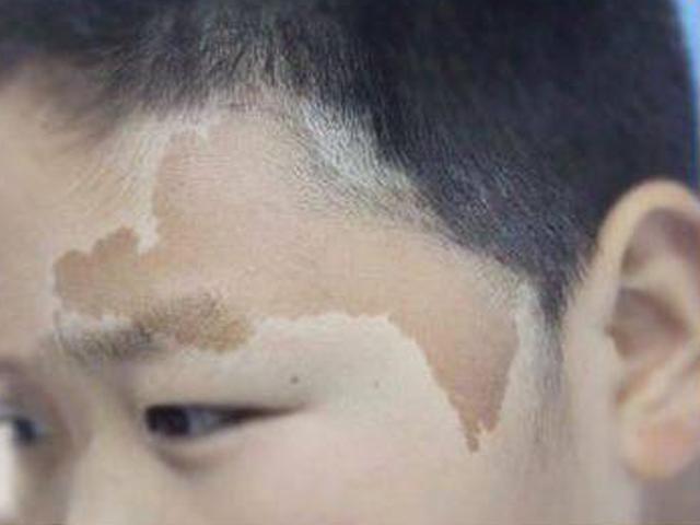 「门道」每个都有特殊意义，看看你家宝宝中招没？婴儿胎记有“门道”