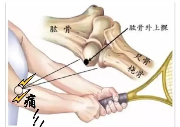 网球运动员在经常训练,比赛打网球时, 肘关节因反复用力伸屈,附着在