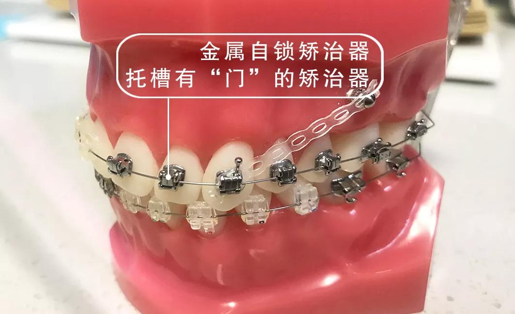 金属陶瓷自锁托槽隐形牙套的优缺点有哪些?