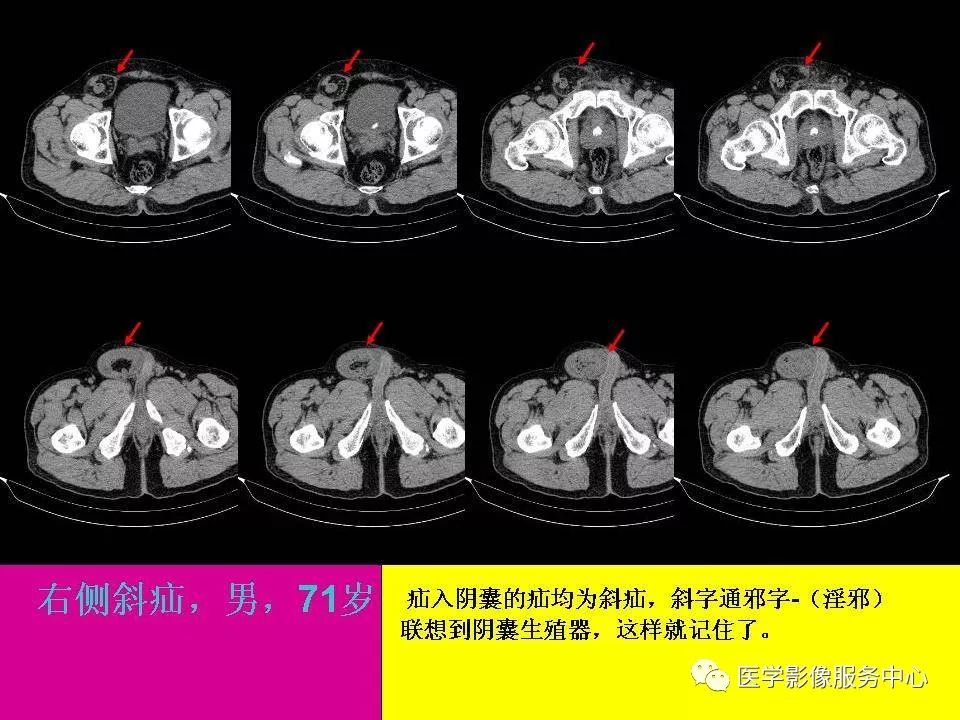 各种疝的ct影像诊断