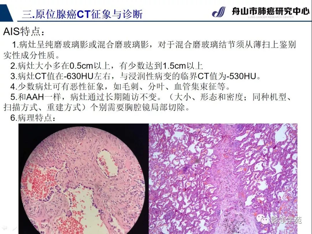 经典早期肺腺癌之肺原位腺癌ct表现