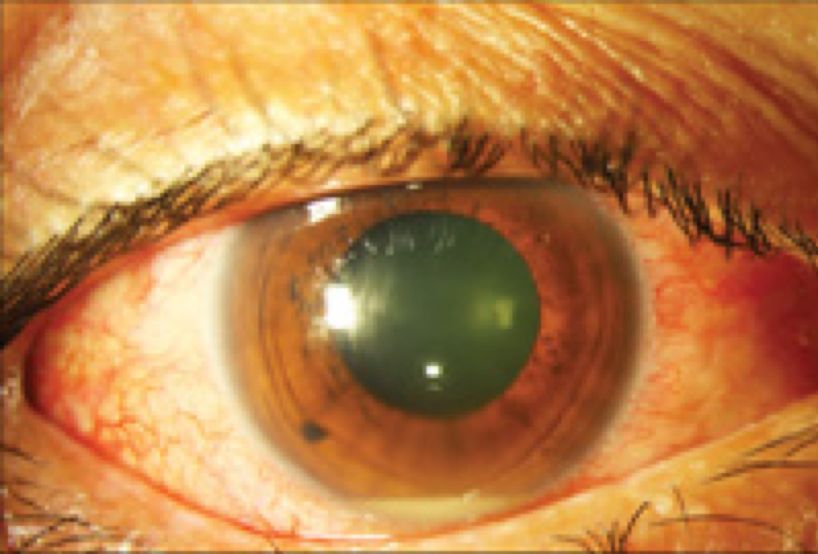 内源性眼内炎是指细菌或真菌通过血液循环播散入眼内,引起葡萄膜