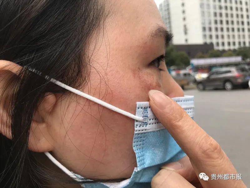 美容变毁容!贵州一女子去美容院祛斑,结果脸