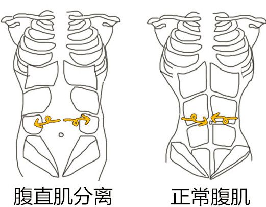 随着孕妈妈体内激素的变化,腹直肌中间的这条线—腹白线,会慢慢发生