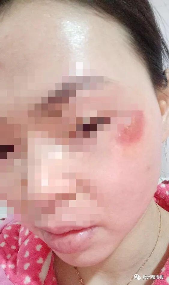 美容变毁容!贵州一女子去美容院祛斑,结果脸
