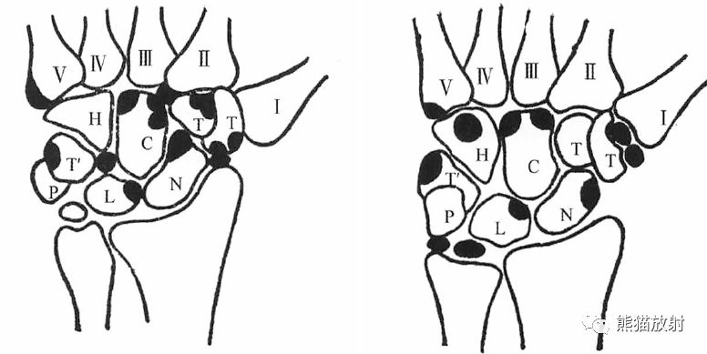 外胫骨;2.钩状骨;3.内楔骨;4.第一跖骨腓侧籽骨;5.第二骰骨;6.