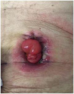 疱疹的后遗症神经痛会持续多久 df096060ec7746928b5fb23d19719e1f.jpeg