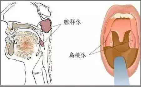 教你如何区分小孩腺样体肥大