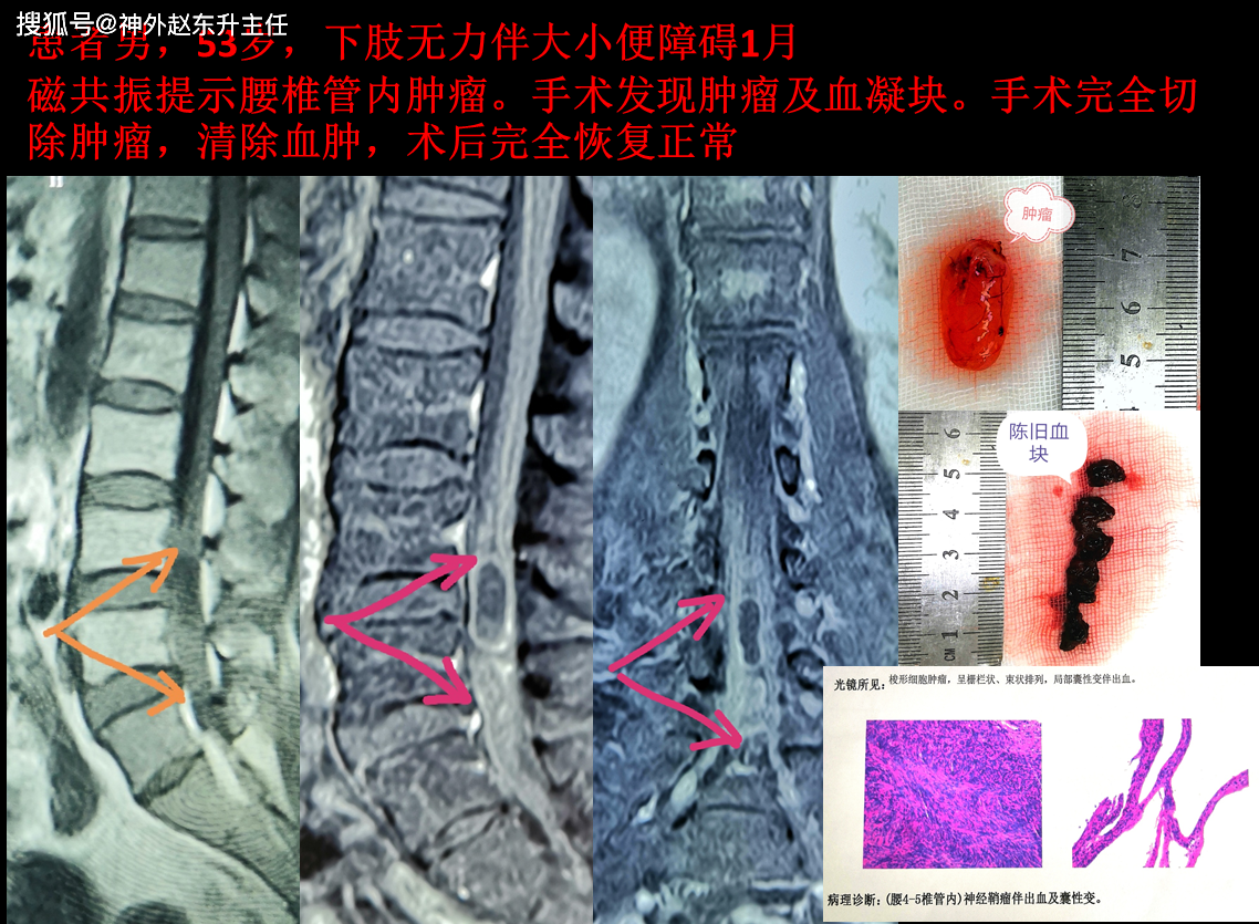 脊髓肿瘤该怎么治疗