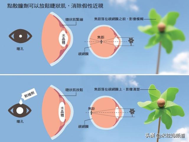 什么情况会引起急性青光眼 29658da1d37c4da08f5992bda2945530.jpeg
