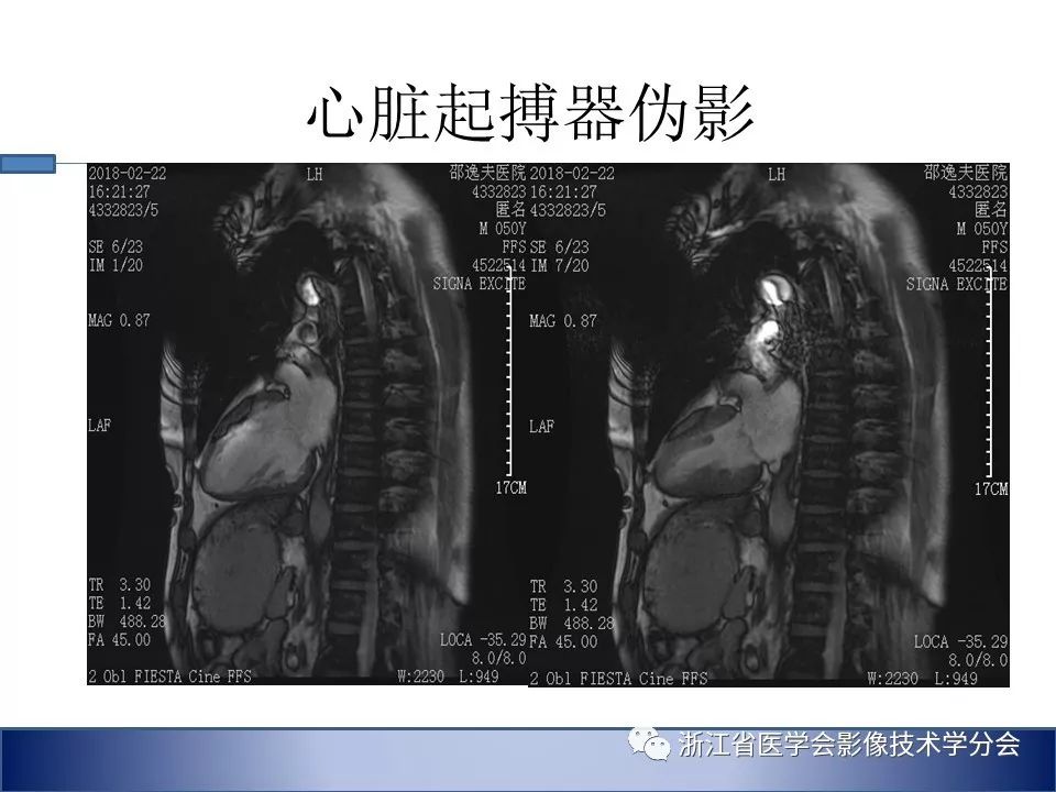心脏磁共振扫描技术要点及伪影控制策略