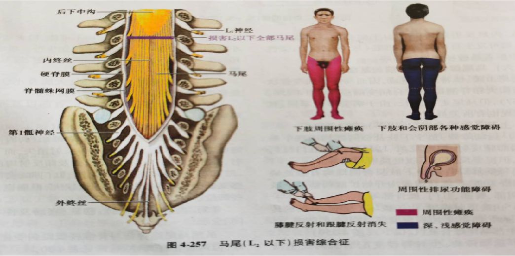 下肢和会阴部下单位瘫,腱发射消失,提睾发射和下腹璧反射均正常;②