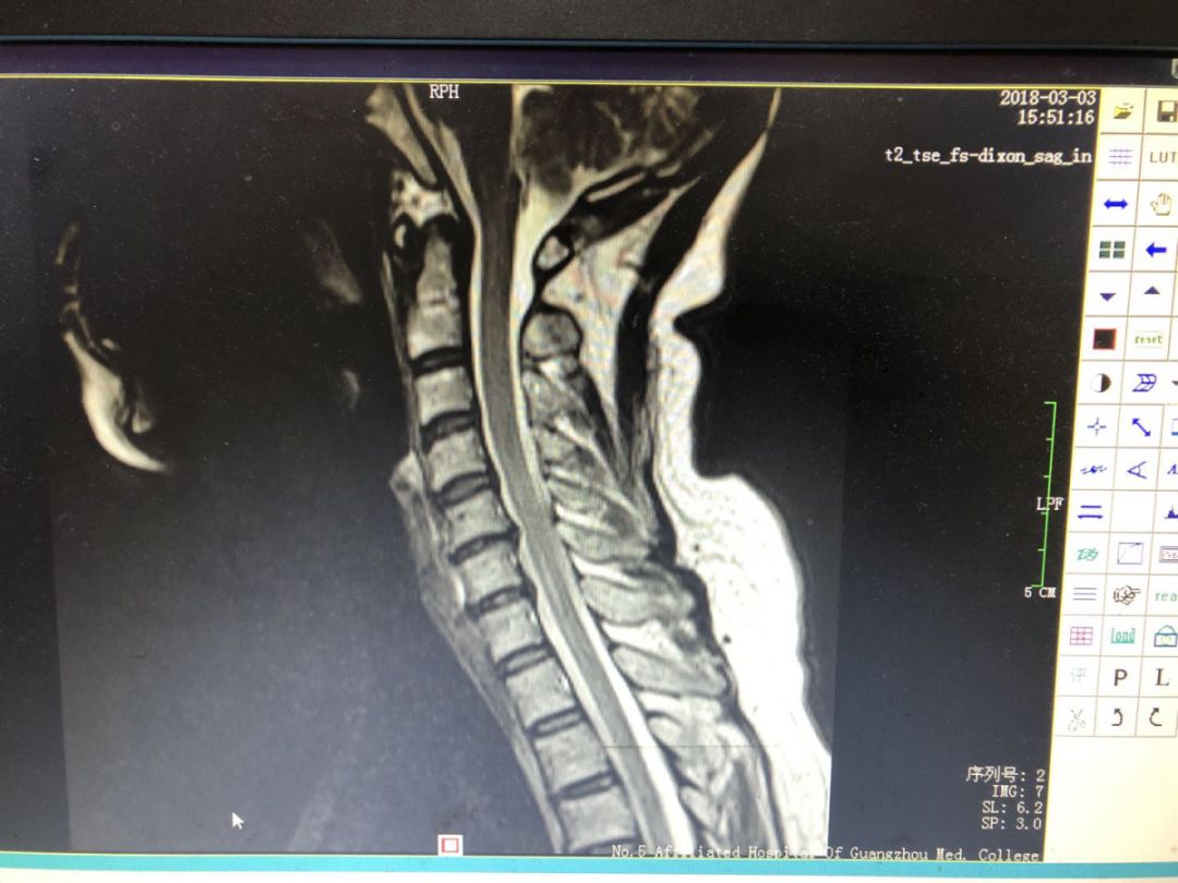 mr显示c4/5/6/7椎间盘突出,且椎间盘缩水严重,硬膜囊受压.