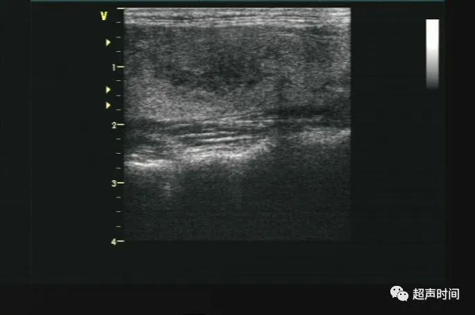 图 5 亚急性甲状腺灰阶超声特征图 6 cdfi 显示低回声区血流信号轻度