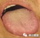除了观察舌苔,舌色外,还要观察舌态,即舌头的动态,看看舌头是不是强硬