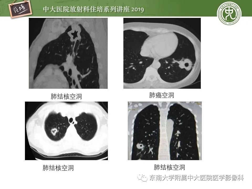 肺空洞病变影像诊断及鉴别