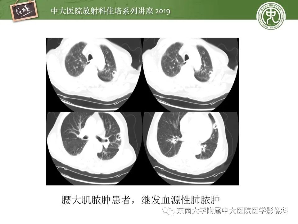 肺空洞病变影像诊断及鉴别