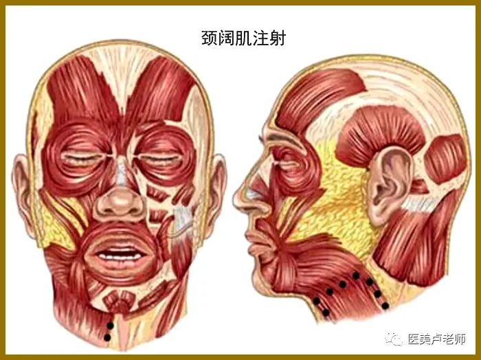 颈阔肌注射:注射点-让患者做出收紧颈阔肌的动作,显示并标记前后缘