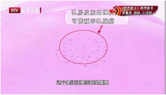 如果乳房 皮肤有很多小坑(橘皮征),可能预示肿瘤阻塞了淋巴管.