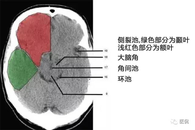 颅脑ct彩色解剖图更有意想不到的学习秘诀