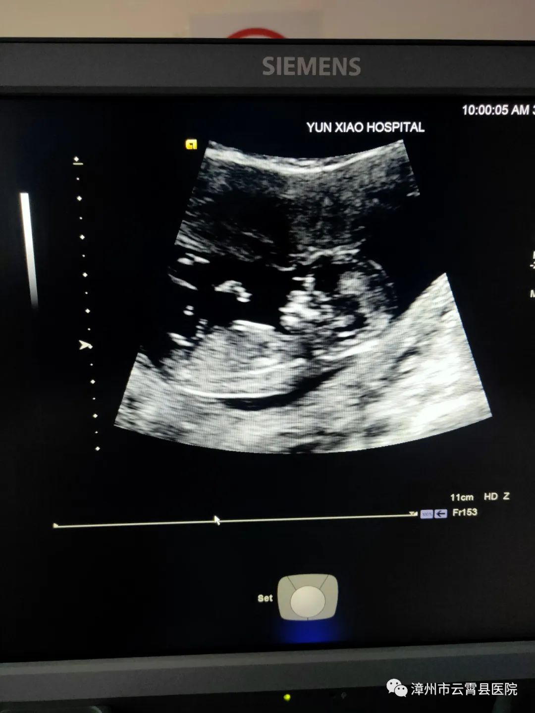 孕13周胎儿二维切面图及彩色血流图用先进的超声仪器(德国西门子)行nt