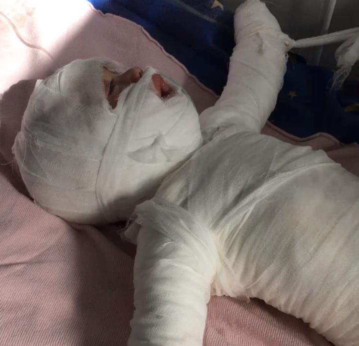 沸水■却跌进一桶沸水中，糊涂妈妈后悔不已11个月大婴儿准备洗澡