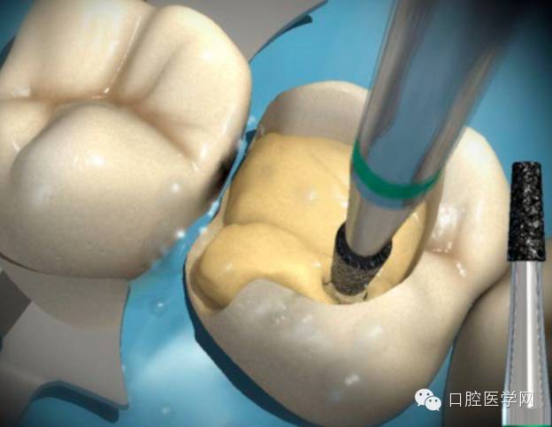 高清图解根管治疗后嵌体修复临床操作程序