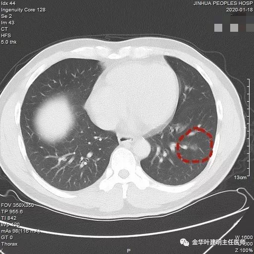 经验积累你的肺结节是否能消失请对照本文