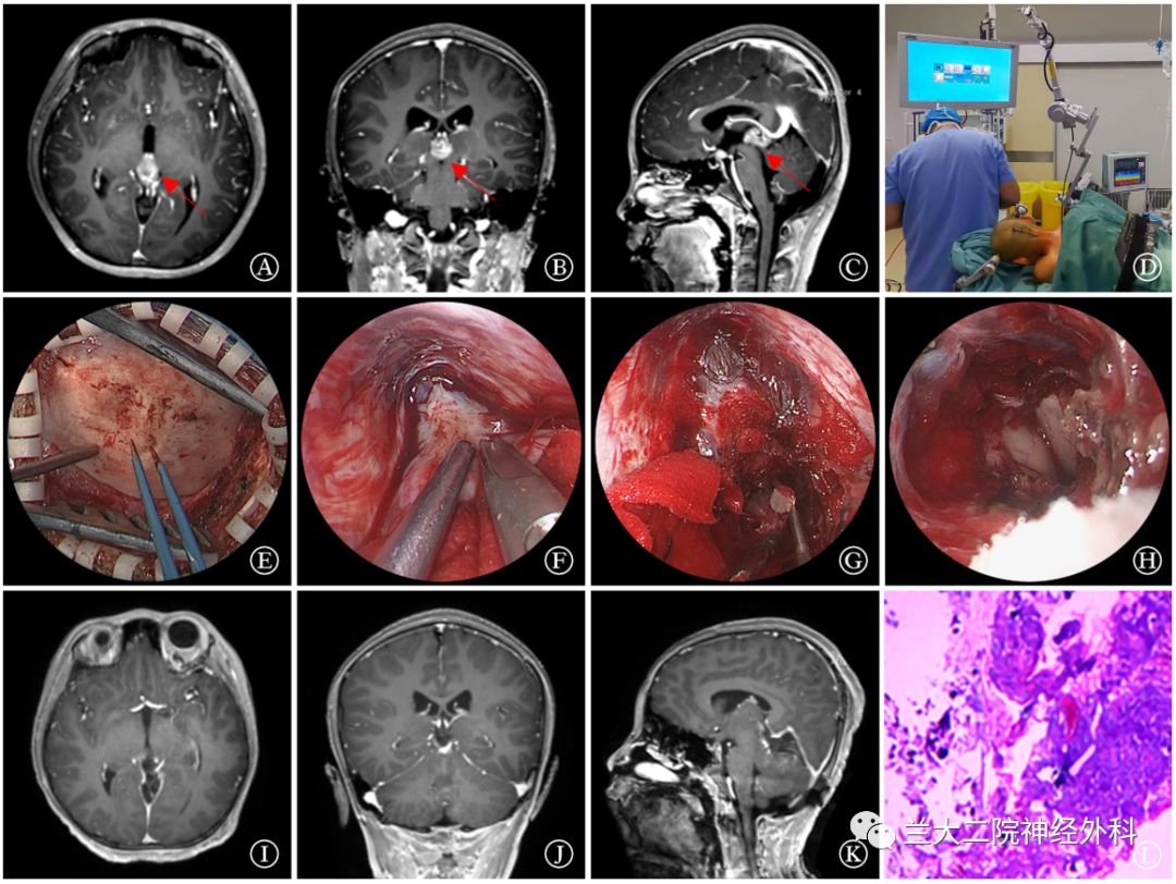 【论著】神经内镜下经幕下小脑上入路切除松果体区肿瘤的临床效果