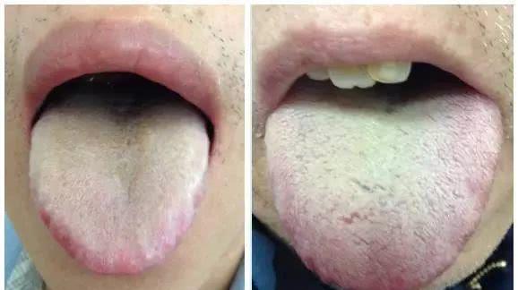 肾湿热舌苔图片 a05a0027db3b4bf1a09a11a5f0a1e6a1.jpeg