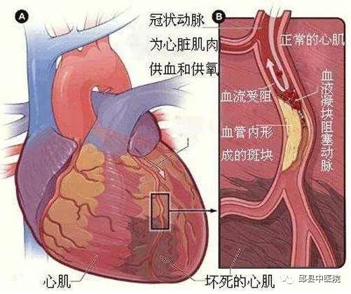 邱县王某患急性心肌梗塞情况危急,中医院医生情急之下