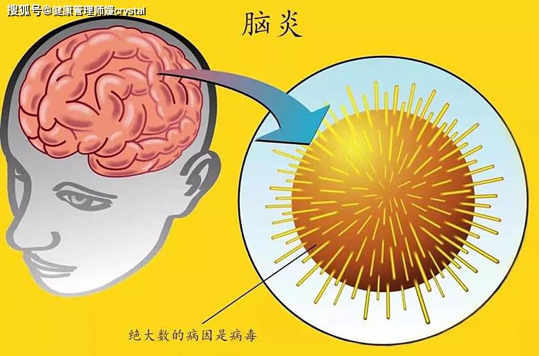 孩子:妈妈以为感冒,用药无缓解,医生:春天小心病毒性脑炎孩子发热