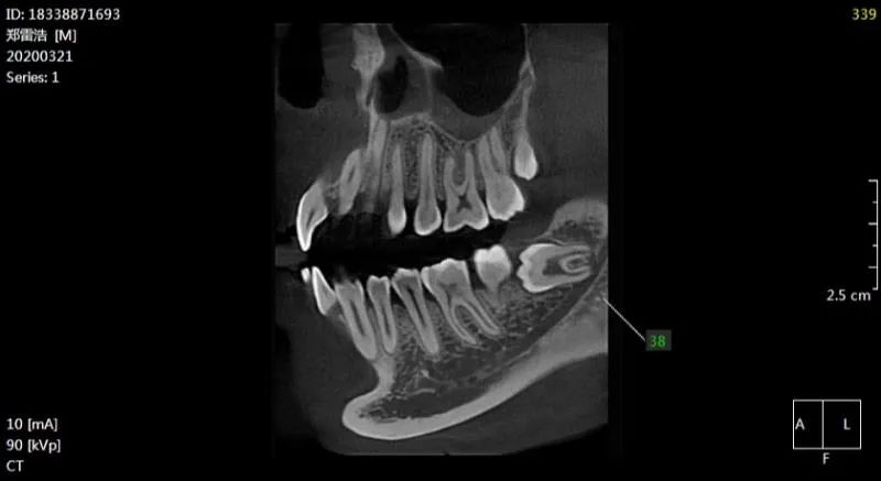 郑xx20200321智齿拔除前检查ct18338871693