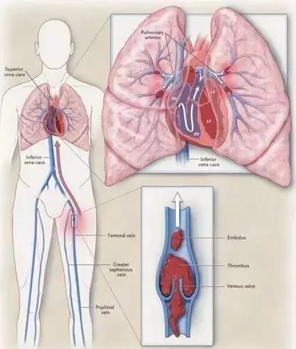 下肢静脉血栓脱落后导致肺栓塞示意图 图|网络