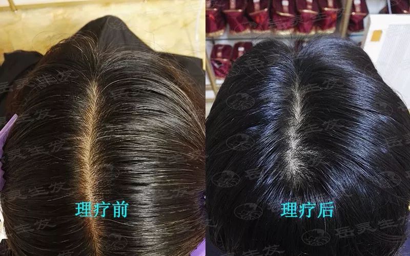 白发会越拔越多吗?