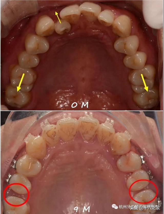 正畸临床病例(六)—简单高效推磨牙向后技巧