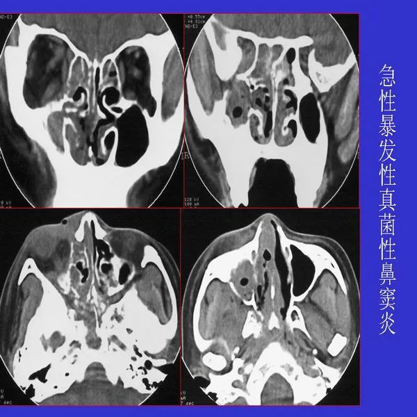 真菌性鼻窦炎影像学诊断