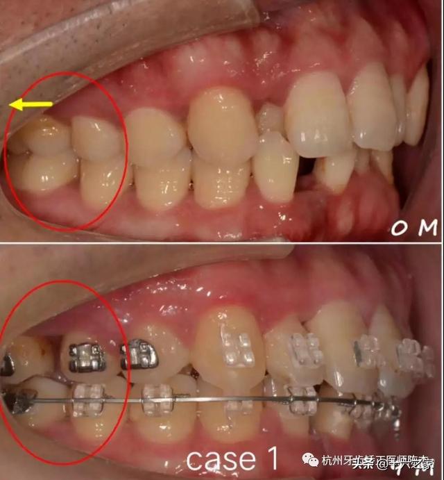 正畸临床病例(六)—简单高效推磨牙向后技巧