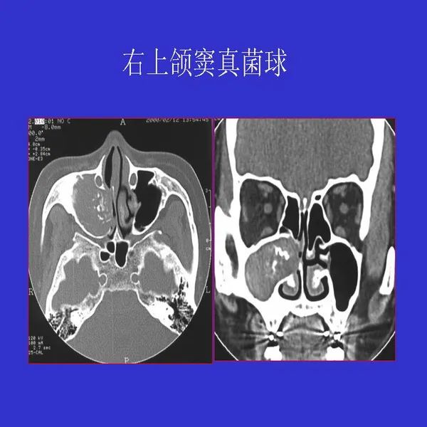 真菌性鼻窦炎影像学诊断