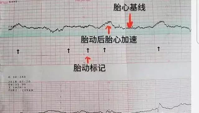 孕晚期胎儿容易缺氧,这项"产检"可动态监测胎儿情况,孕妈需重视!