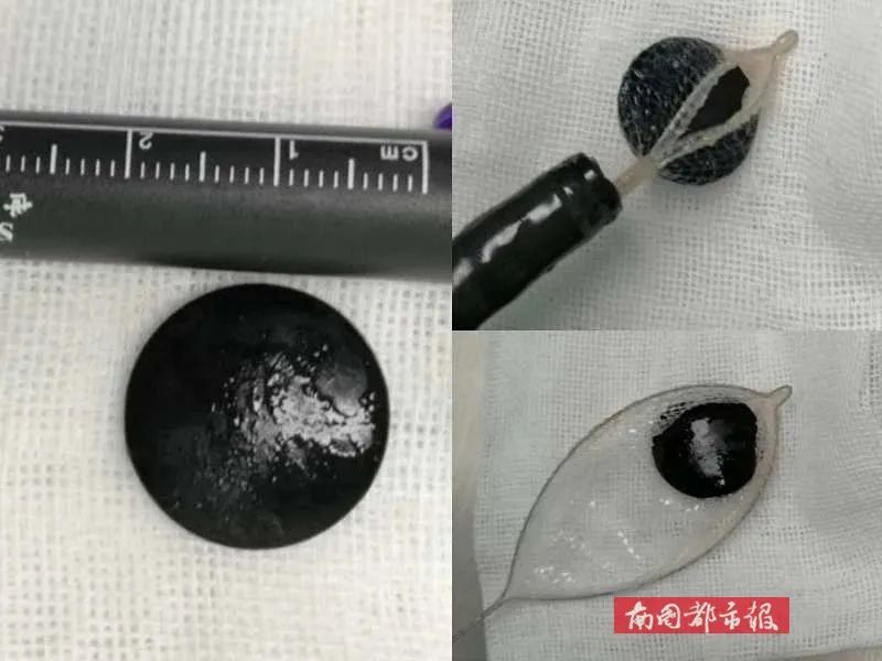 #异物#拍完片子大吃一惊！家长都应该看看....海口1岁女孩一吃就吐
