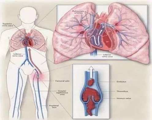 有血栓的人口比例_腿上有血栓真人图片(2)