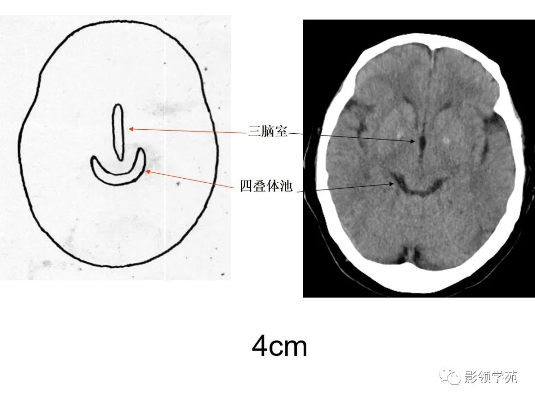 头部ct影像解剖