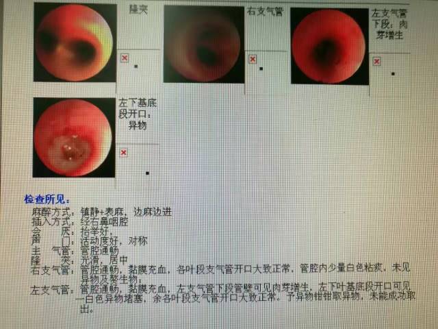 「少买」家长们注意，这些衣服少买！一件衣服害孩子反复肺炎3个月