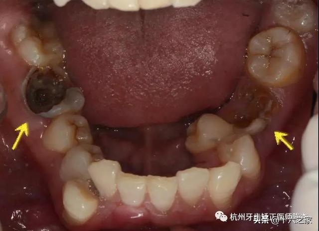正畸临床病例(四)——磨牙平移的方法与技巧