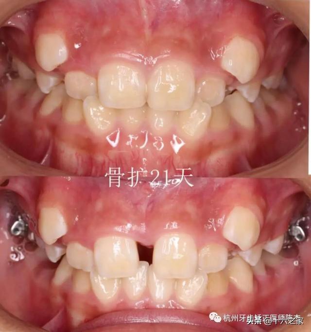 正畸临床病例八横向先行扩弓的方法与技巧