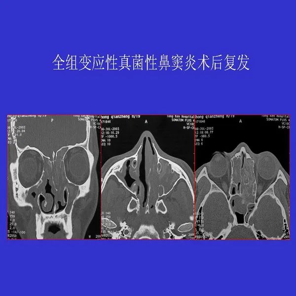 真菌性鼻窦炎影像学诊断